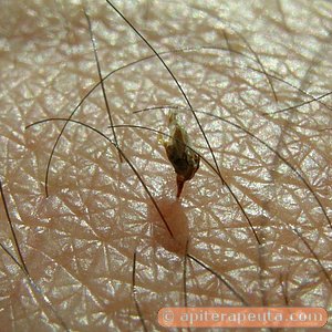 aguijon de abeja en una picadura de apiterapia HD